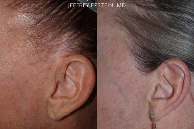 Special Cases Before and after in Miami, FL, Paciente 41122