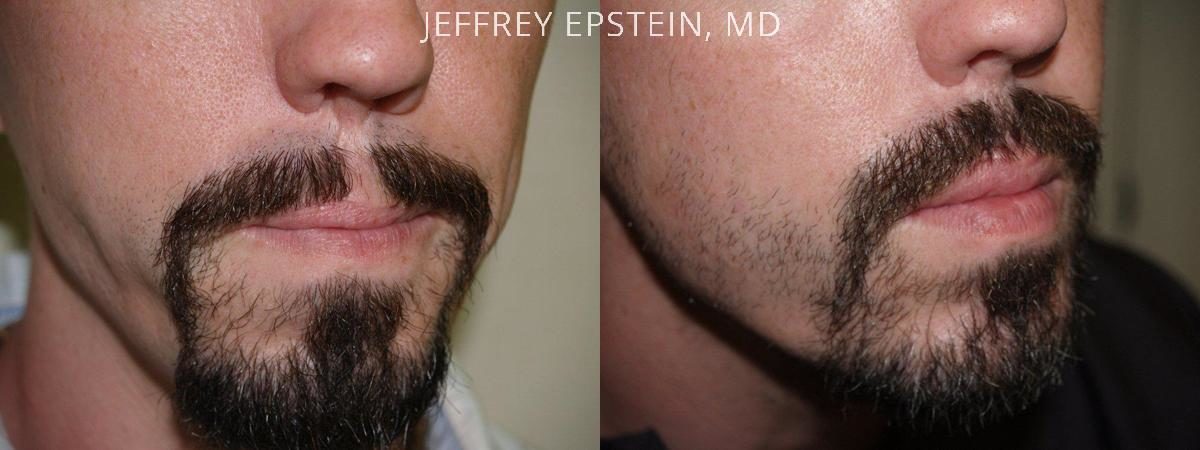 Special Cases Before and after in Miami, FL, Paciente 41127