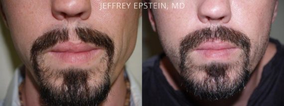 Casos Especiales Before and after in Miami, FL, Paciente 96791