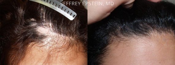 Casos Especiales Before and after in Miami, FL, Paciente 96736