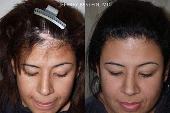 Casos Especiales Before and after in Miami, FL, Paciente 96736