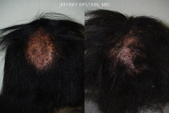 Special Cases Before and after in Miami, FL, Paciente 41142