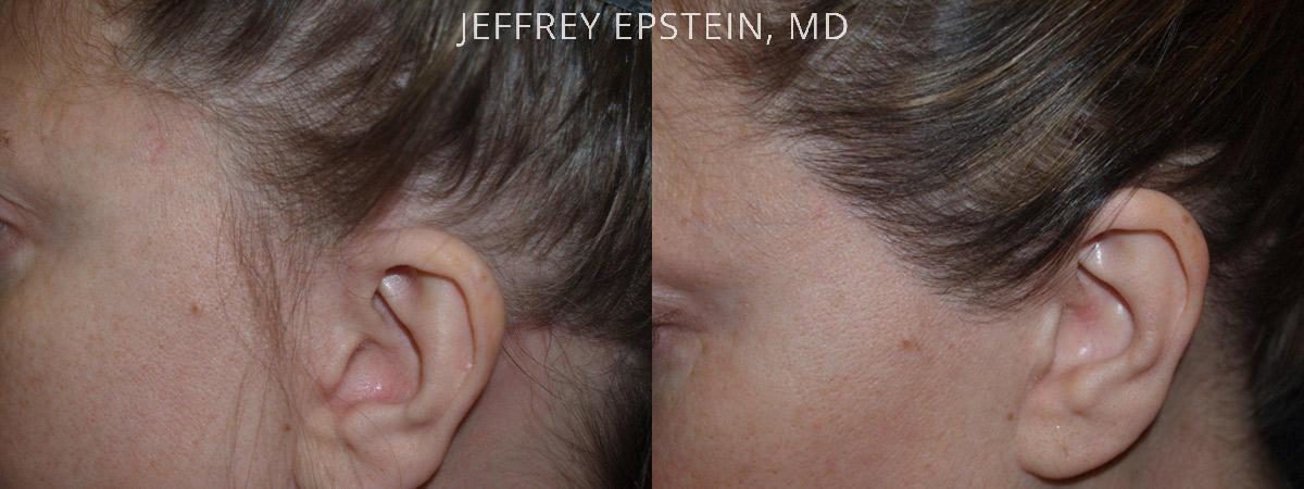 Special Cases Before and after in Miami, FL, Paciente 41145