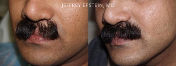Casos Especiales Before and after in Miami, FL, Paciente 96660