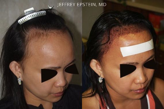 Casos Especiales Before and after in Miami, FL, Paciente 96581