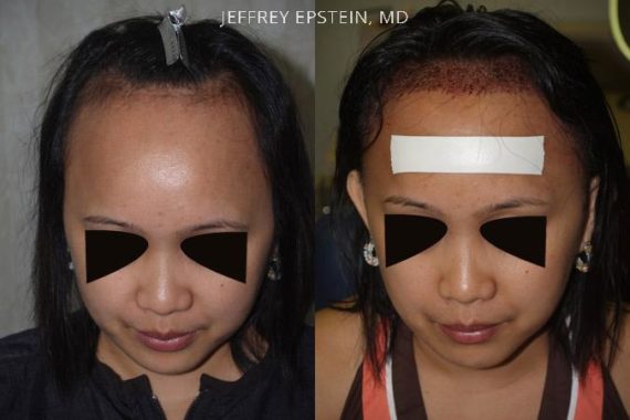 Casos Especiales Before and after in Miami, FL, Paciente 96581