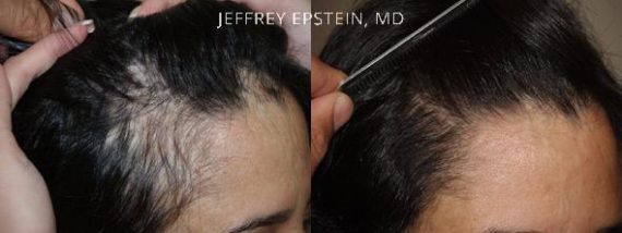 Casos Especiales Before and after in Miami, FL, Paciente 96498