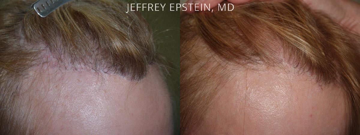 Special Cases Before and after in Miami, FL, Paciente 41203