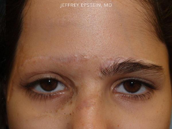 Special Cases Before and after in Miami, FL, Paciente 41215