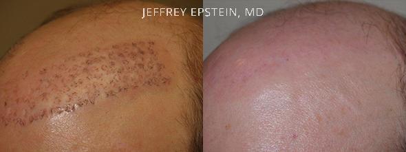Special Cases Before and after in Miami, FL, Paciente 41251