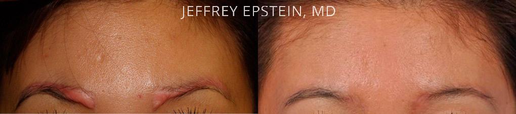 Special Cases Before and after in Miami, FL, Paciente 41272