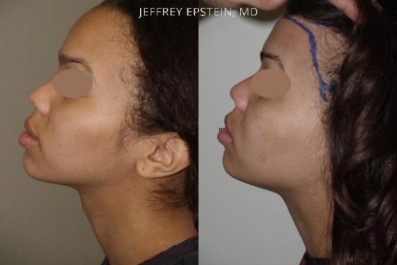 Casos Especiales Before and after in Miami, FL, Paciente 95834