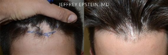 Casos Especiales Before and after in Miami, FL, Paciente 95772