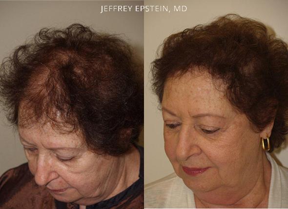 Hair Transplants for Women Before and after in Miami, FL, Paciente 41406