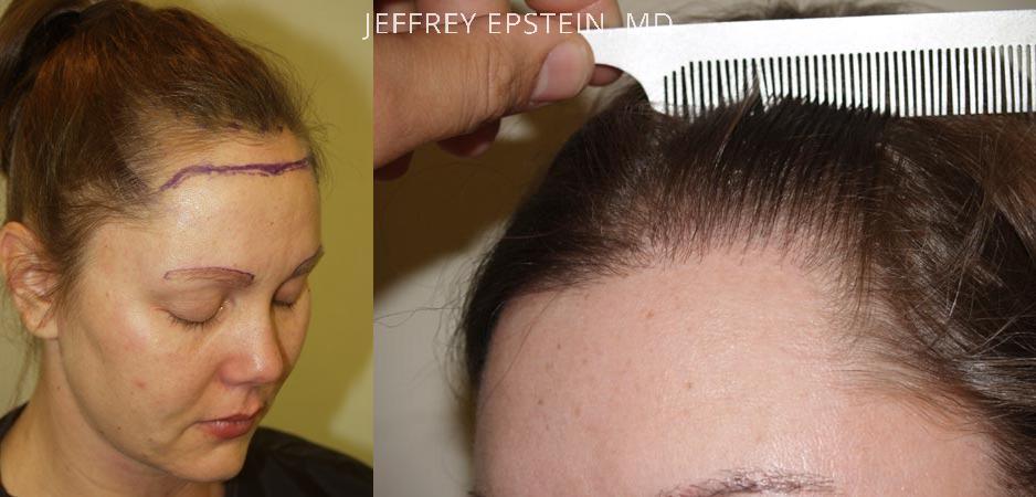 Hair Transplants for Women Before and after in Miami, FL, Paciente 41415