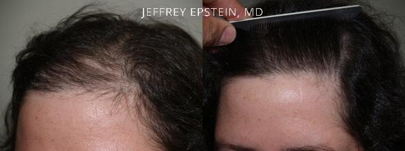 Hair Transplants for Women Before and after in Miami, FL, Paciente 41477