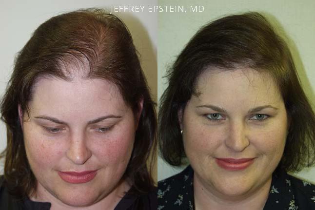 Hair Transplants for Women Before and after in Miami, FL, Paciente 41484