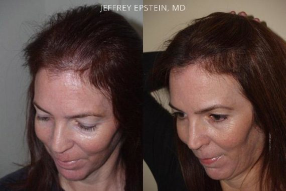 Hair Transplants for Women Before and after in Miami, FL, Paciente 41499