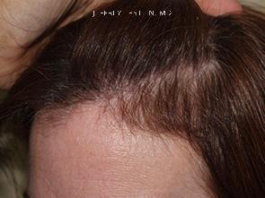 Hair Transplants for Women Before and after in Miami, FL, Paciente 41499