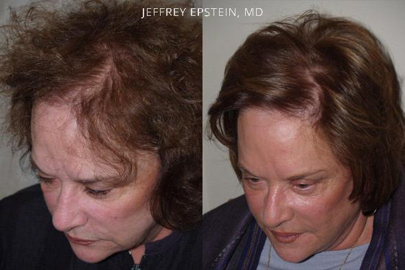 Hair Transplants for Women Before and after in Miami, FL, Paciente 41507