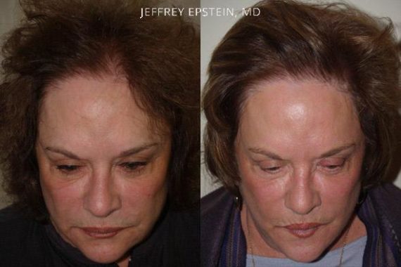 Hair Transplants for Women Before and after in Miami, FL, Paciente 41507