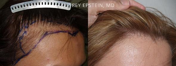 Hair Transplants for Women Before and after in Miami, FL, Paciente 41514