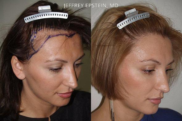 Hair Transplants for Women Before and after in Miami, FL, Paciente 41514