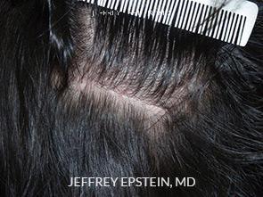 Hair Transplants for Women Before and after in Miami, FL, Paciente 41531