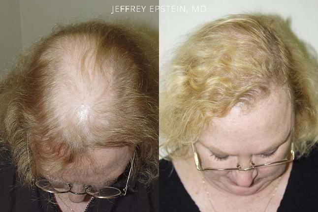Hair Transplants for Women Before and after in Miami, FL, Paciente 41538