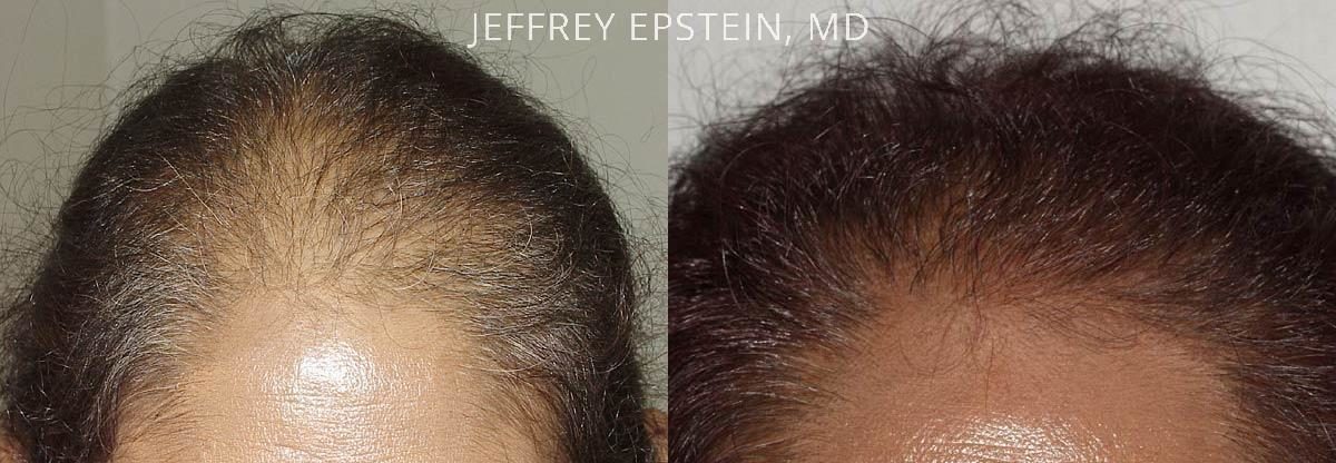 Hair Transplants for Women Before and after in Miami, FL, Paciente 41546