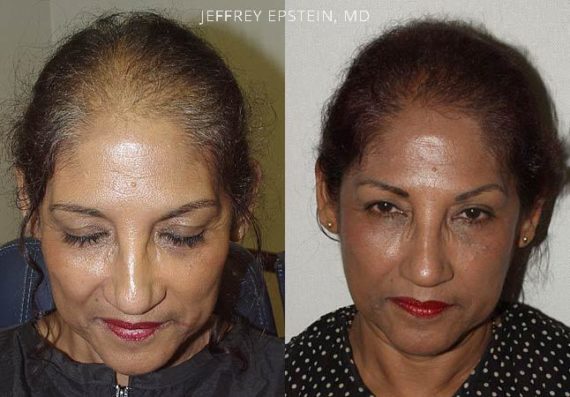 Trasplante de Pelo en Mujeres Before and after in Miami, FL, Paciente 102074