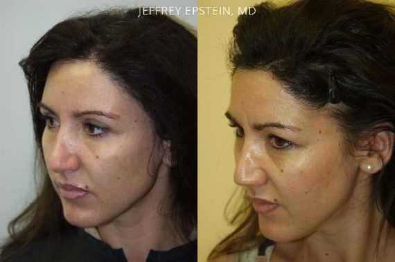 Trasplante de Pelo en Mujeres Before and after in Miami, FL, Paciente 102029