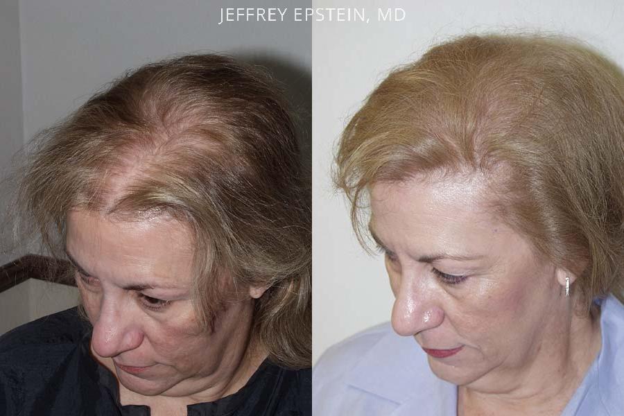 Hair Transplants for Women Before and after in Miami, FL, Paciente 41563