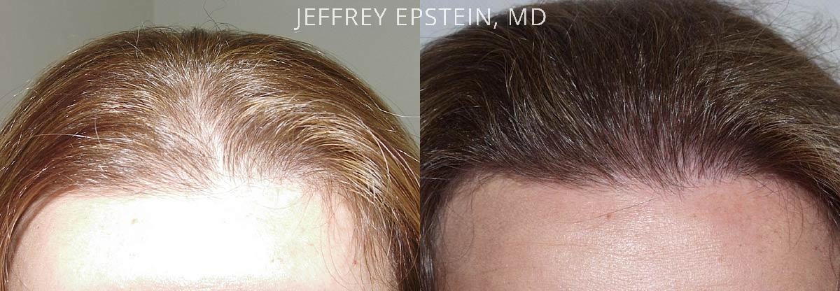 Hair Transplants for Women Before and after in Miami, FL, Paciente 41566