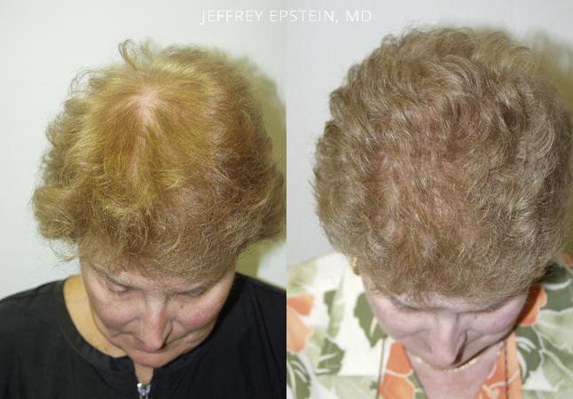 Hair Transplants for Women Before and after in Miami, FL, Paciente 41571