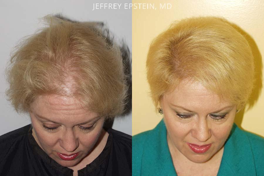 Hair Transplants for Women Before and after in Miami, FL, Paciente 41574
