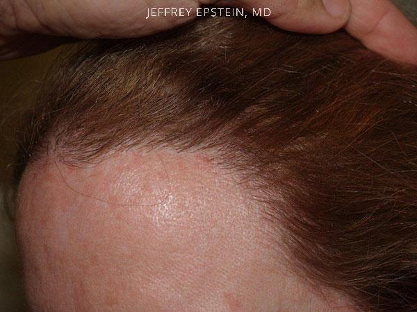 Hair Transplants for Women Before and after in Miami, FL, Paciente 41580
