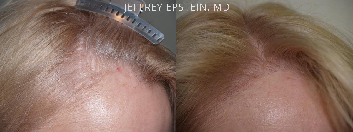 Hair Transplants for Women Before and after in Miami, FL, Paciente 41594