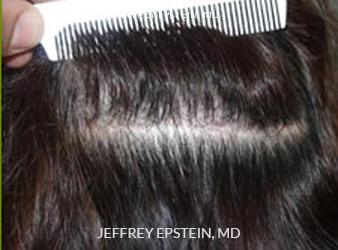 Hair Transplants for Women Before and after in Miami, FL, Paciente 41601
