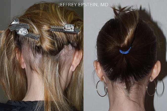 Hair Transplants for Women Before and after in Miami, FL, Paciente 41628