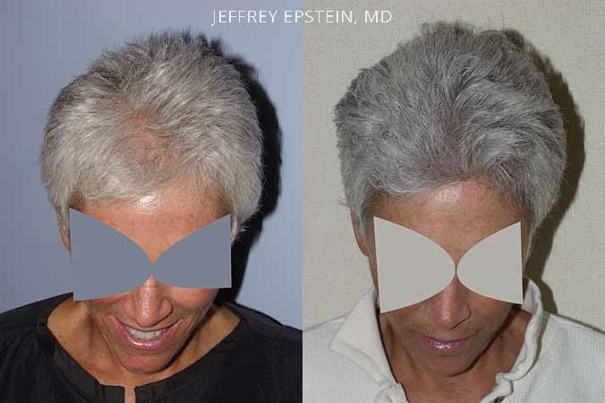 Hair Transplants for Women Before and after in Miami, FL, Paciente 41641