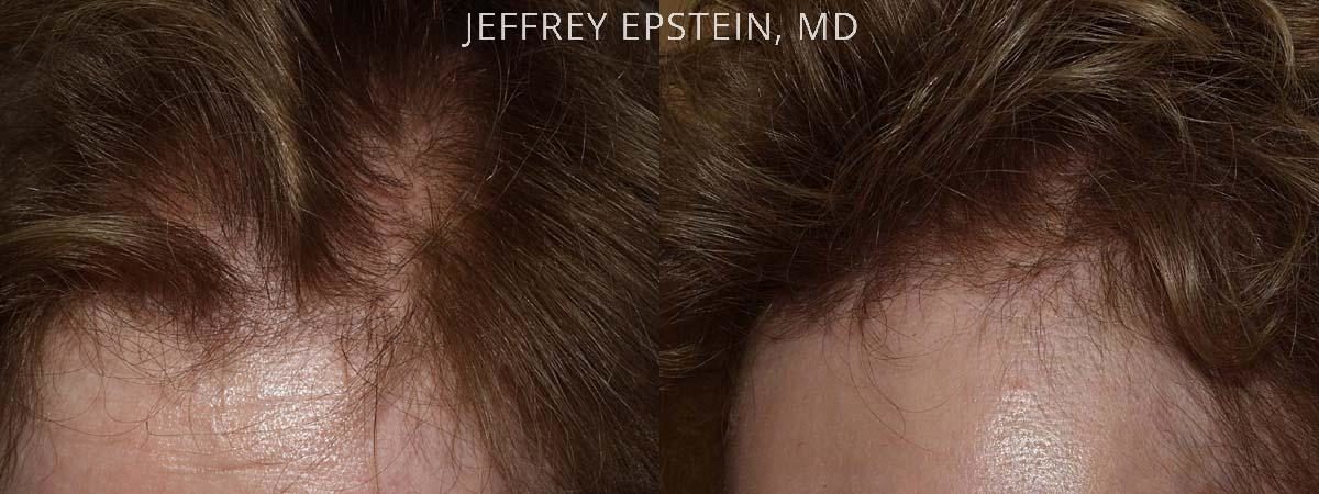 Hair Transplants for Women Before and after in Miami, FL, Paciente 41646