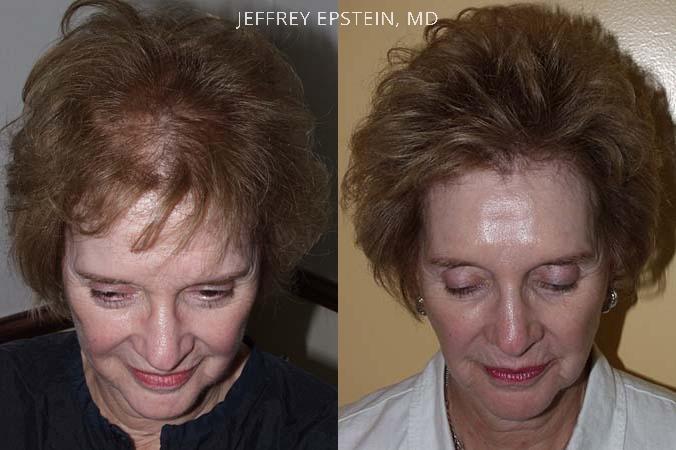 Hair Transplants for Women Before and after in Miami, FL, Paciente 41646