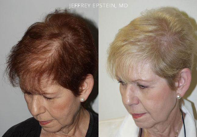 Hair Transplants for Women Before and after in Miami, FL, Paciente 41664