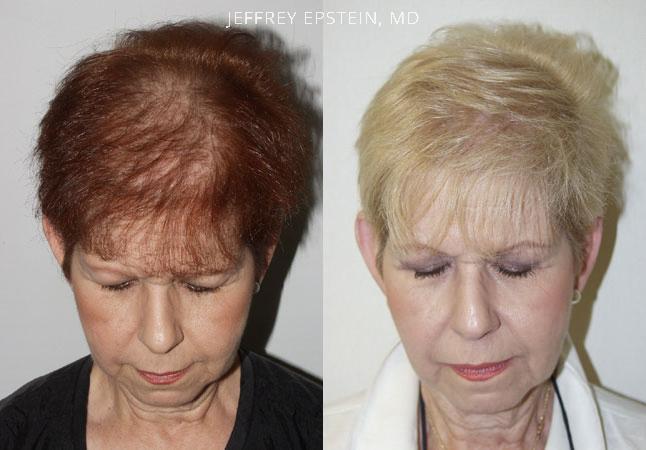 Hair Transplants for Women Before and after in Miami, FL, Paciente 41664
