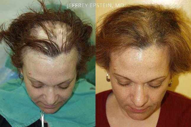 Hair Transplants for Women Before and after in Miami, FL, Paciente 41669