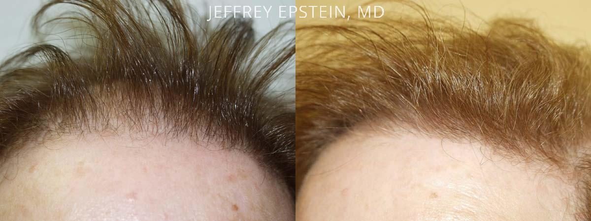 Hair Transplants for Women Before and after in Miami, FL, Paciente 41672