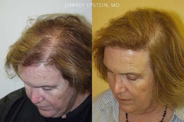 Hair Transplants for Women Before and after in Miami, FL, Paciente 41672