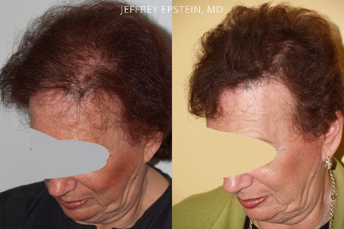 Hair Transplants for Women Before and after in Miami, FL, Paciente 41677