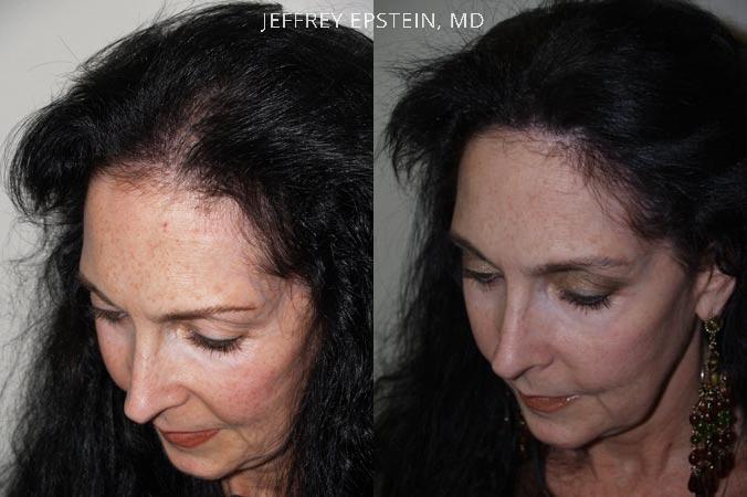 Hair Transplants for Women Before and after in Miami, FL, Paciente 41680